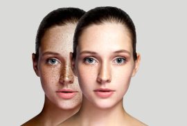 woman dark spots